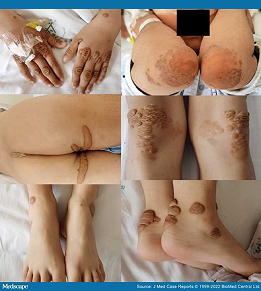hypercholesterolaemia-icon
